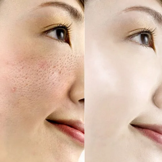 24993 melasma skin whitening