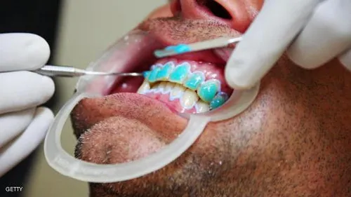 25001 professional teeth whitening utah