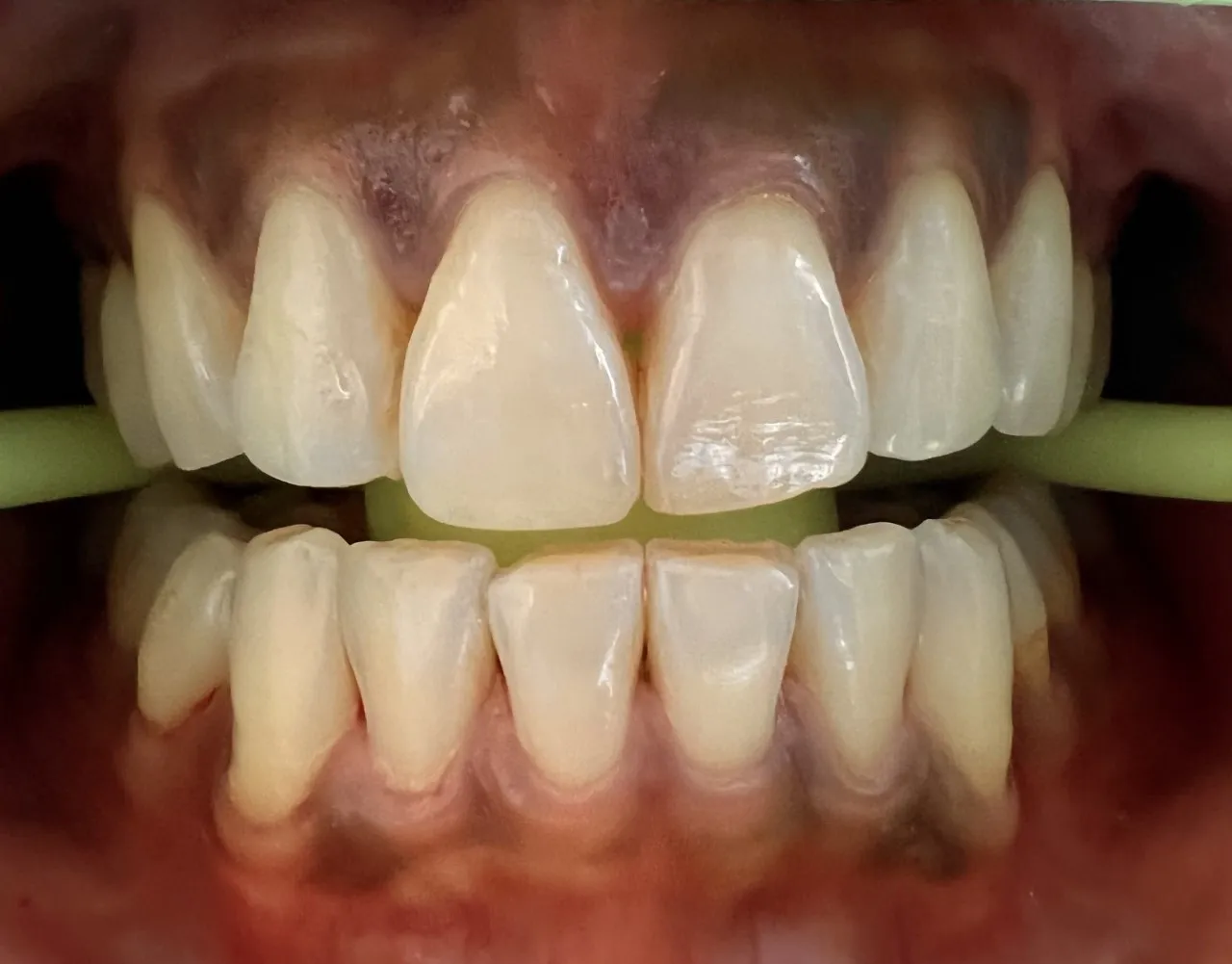25004 teeth whitening products