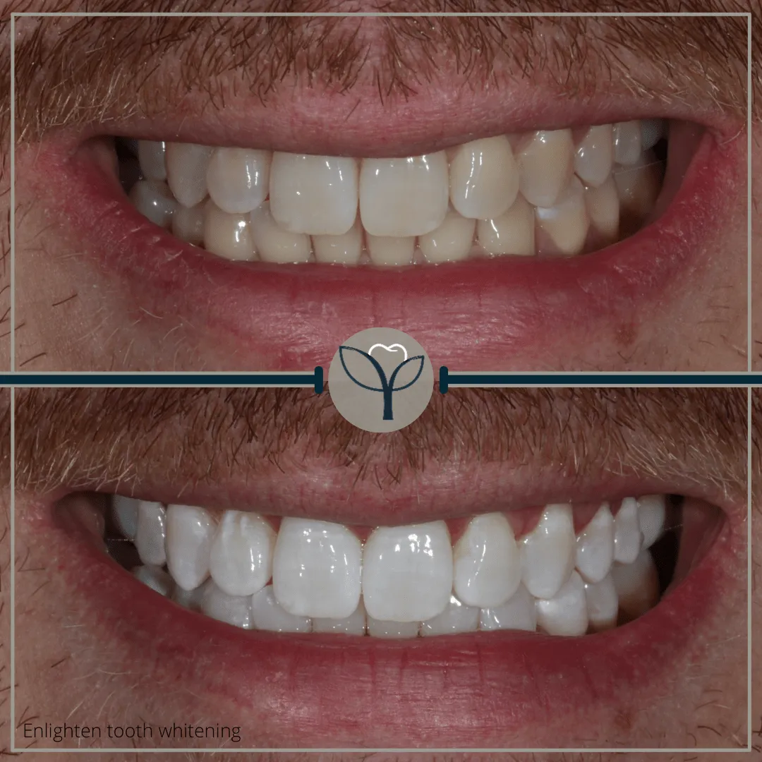 25006 teeth whitening consultation manchester