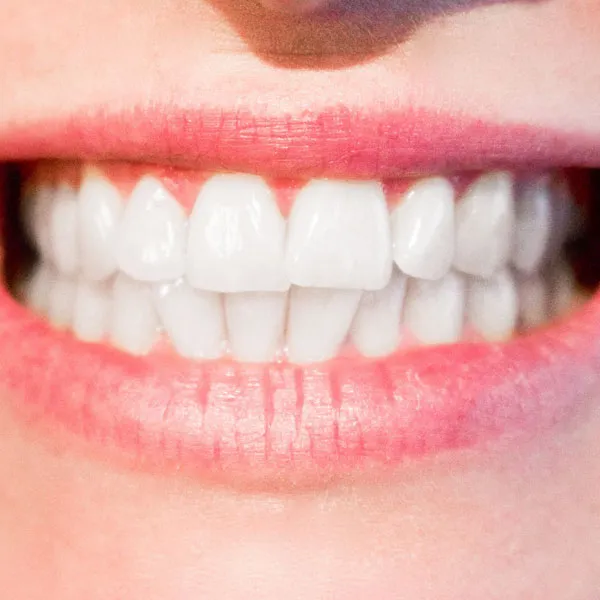 25011 teeth whitening surrey take home kit