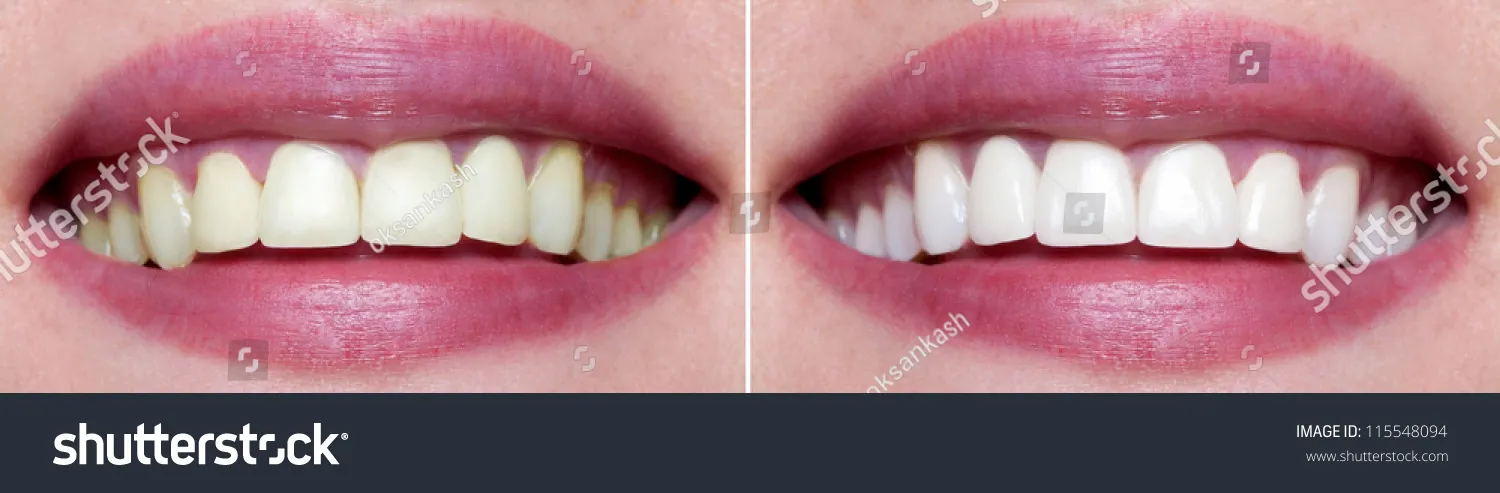 25017 venus teeth whitening benefits