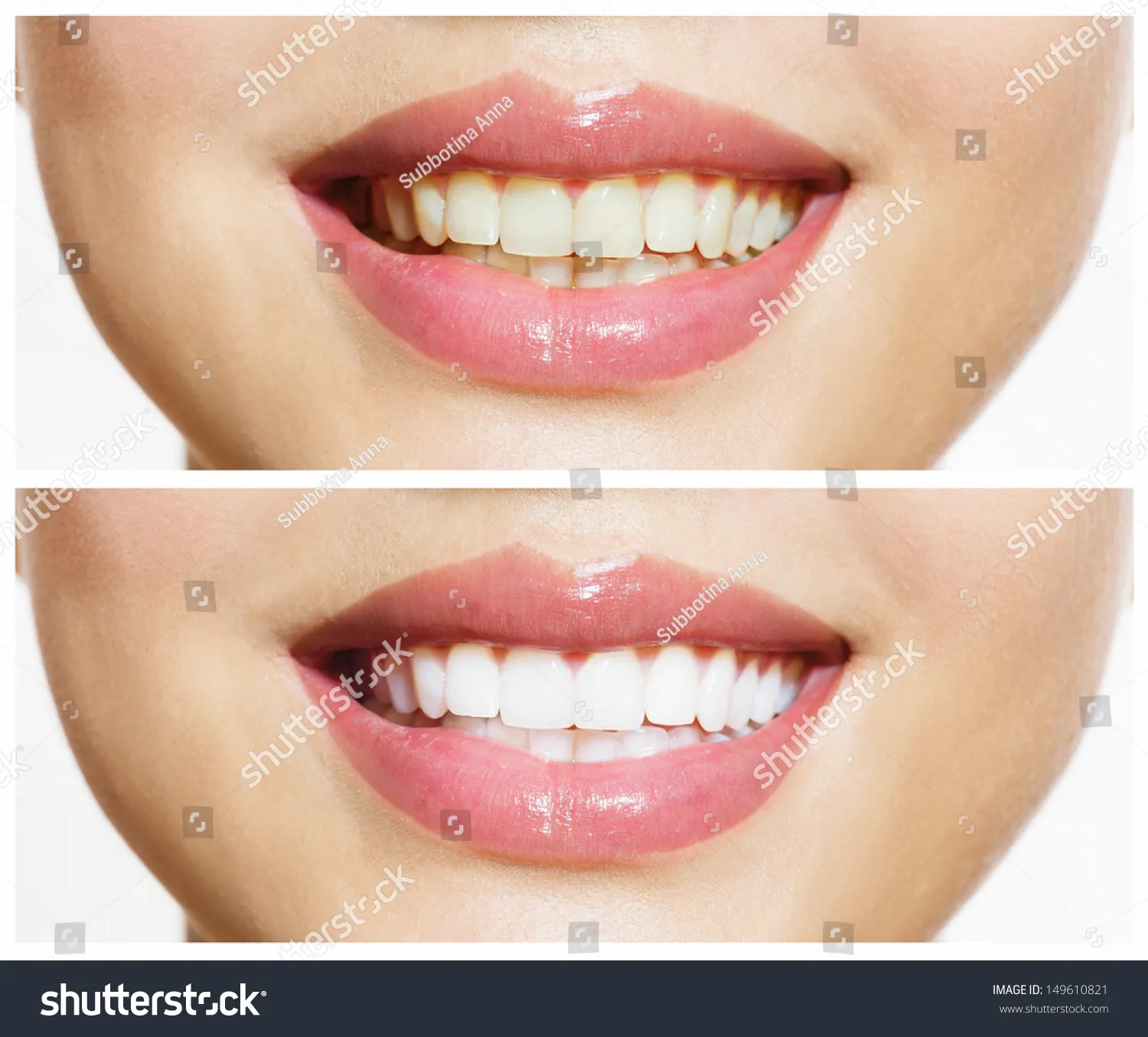 25017 venus teeth whitening care