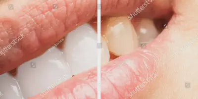 /img/25017-venus-teeth-whitening-comparison.webp