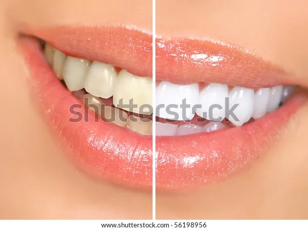 25017 venus teeth whitening cost