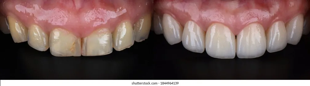 25017 venus teeth whitening procedure