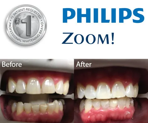 25017 venus teeth whitening results