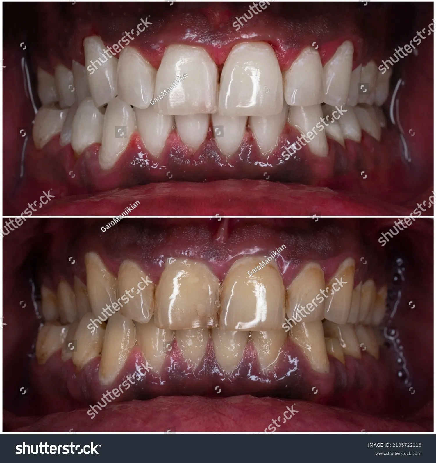 25017 venus teeth whitening smile