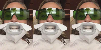 /img/25018-dental-checkup-after-whitening.webp
