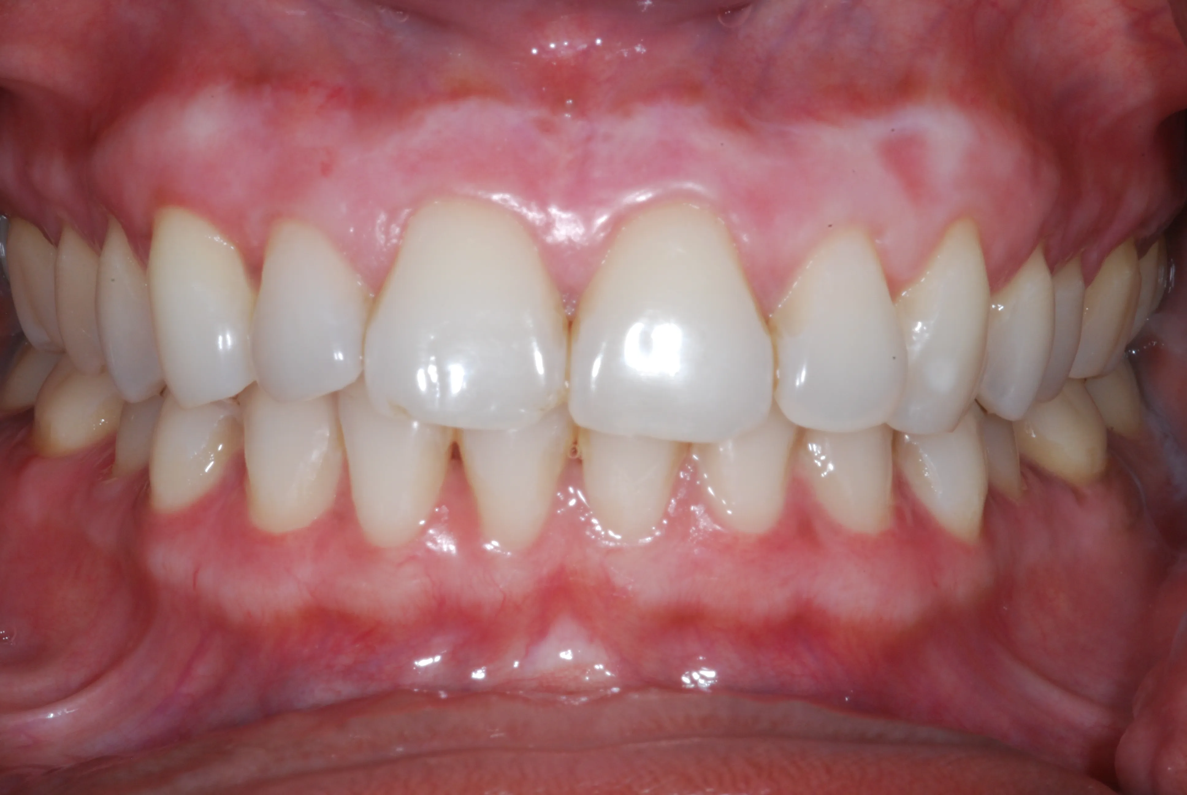 25024 teeth whitening white spots 3