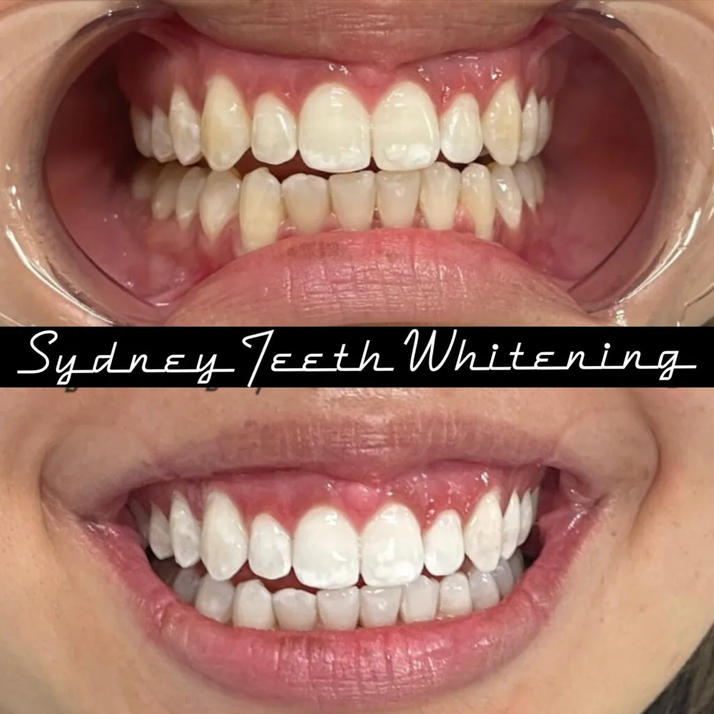 25024 teeth whitening white spots 4