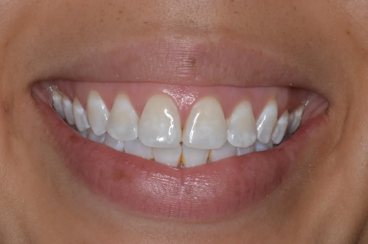 /img/25024-teeth-whitening-white-spots-7.webp