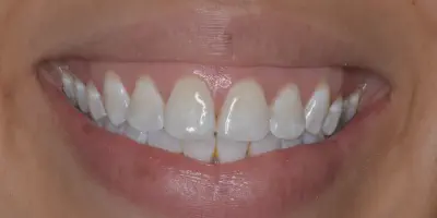 /img/25024-teeth-whitening-white-spots-7.webp