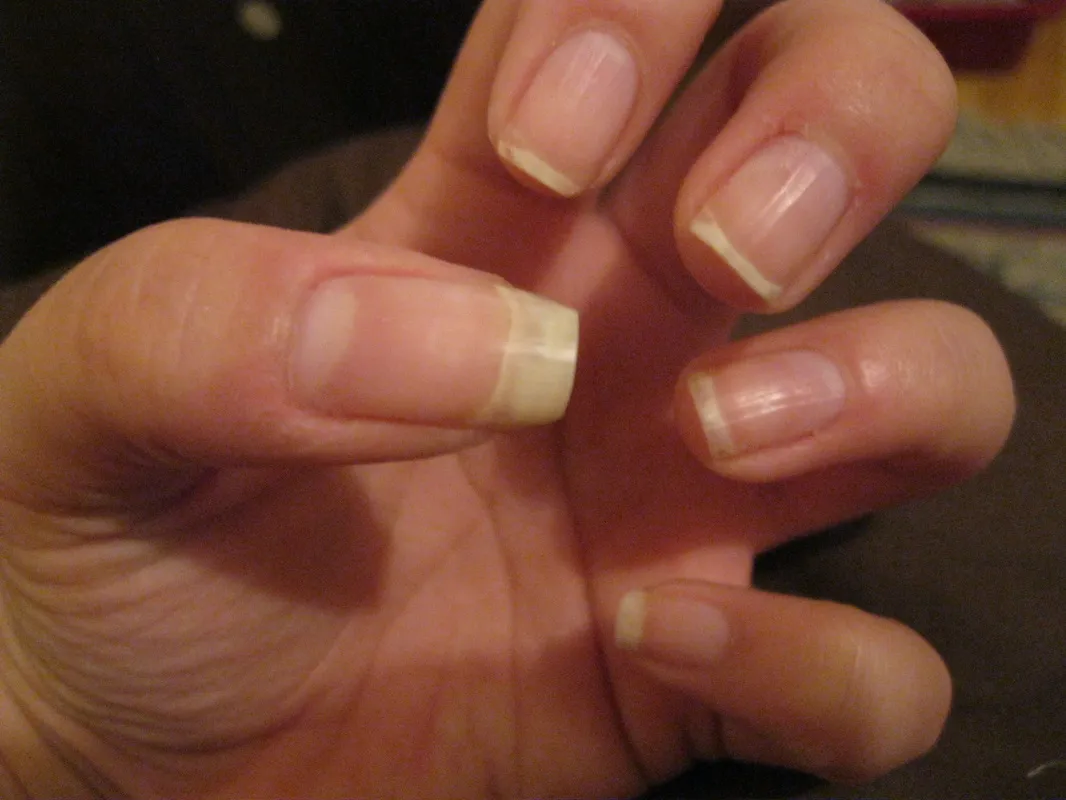 25025 yellow nails discoloration