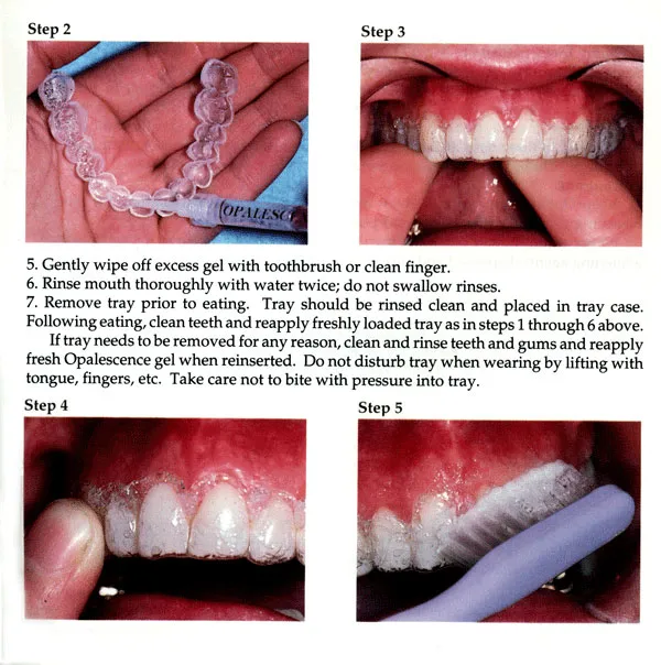 25027 aftercare teeth whitening