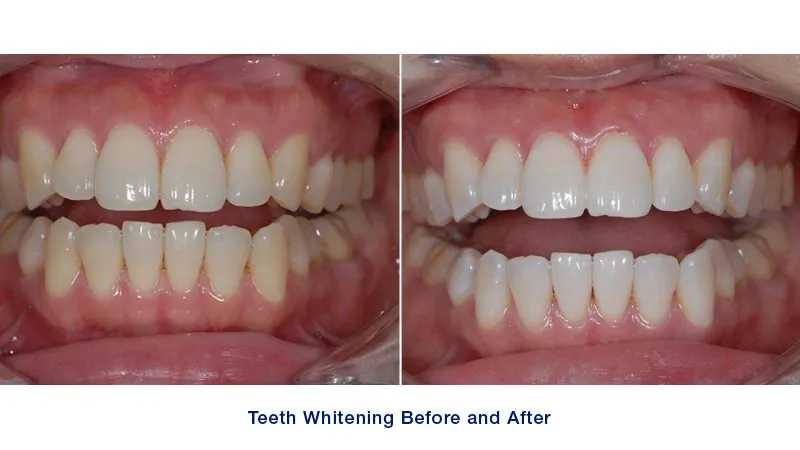 25027 teeth whitening sensitivity