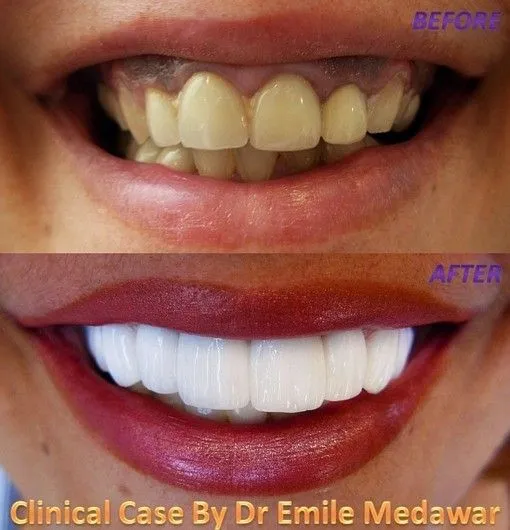 25029 veneers vs whitening