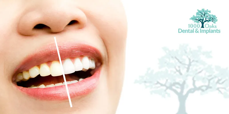 25029 whitening strips teeth