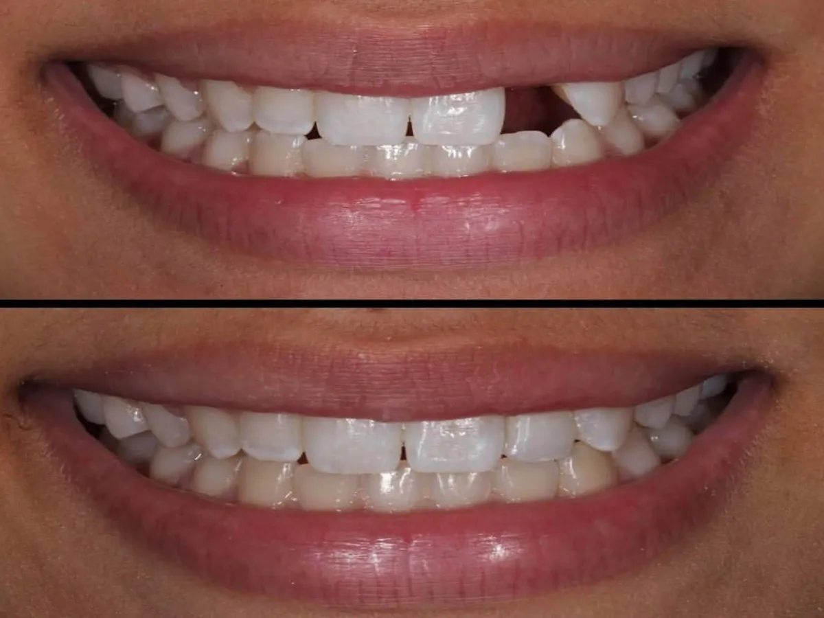 25033 teeth whitening procedure