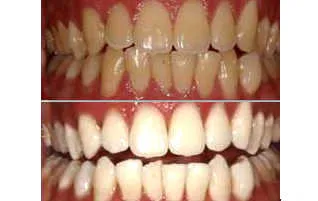 /img/25033-teeth-whitening-results.webp