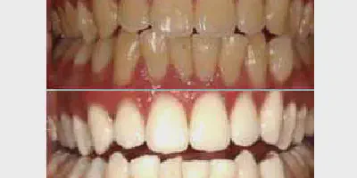 /img/25033-teeth-whitening-results.webp